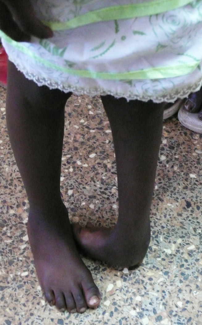Young girl clubfoot before