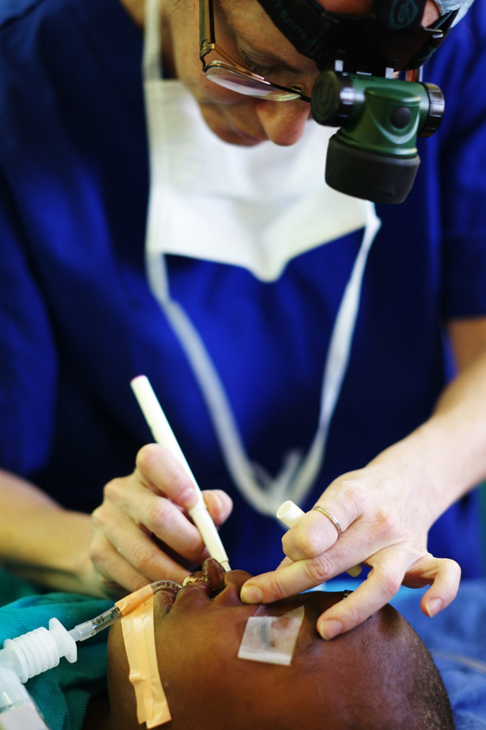 Intra operative repair of cleft lip