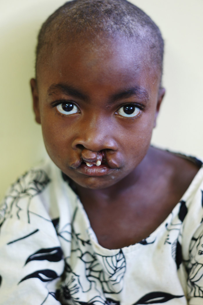 12 year old girl cleft lip before