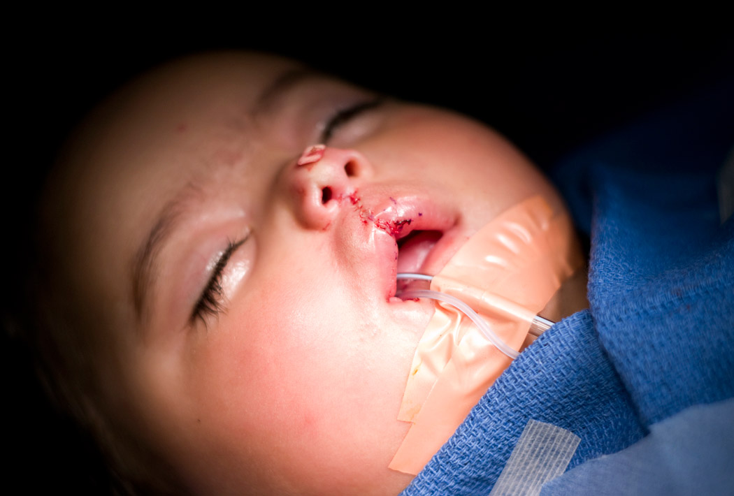 Baby immediate post operative cleft lip repair