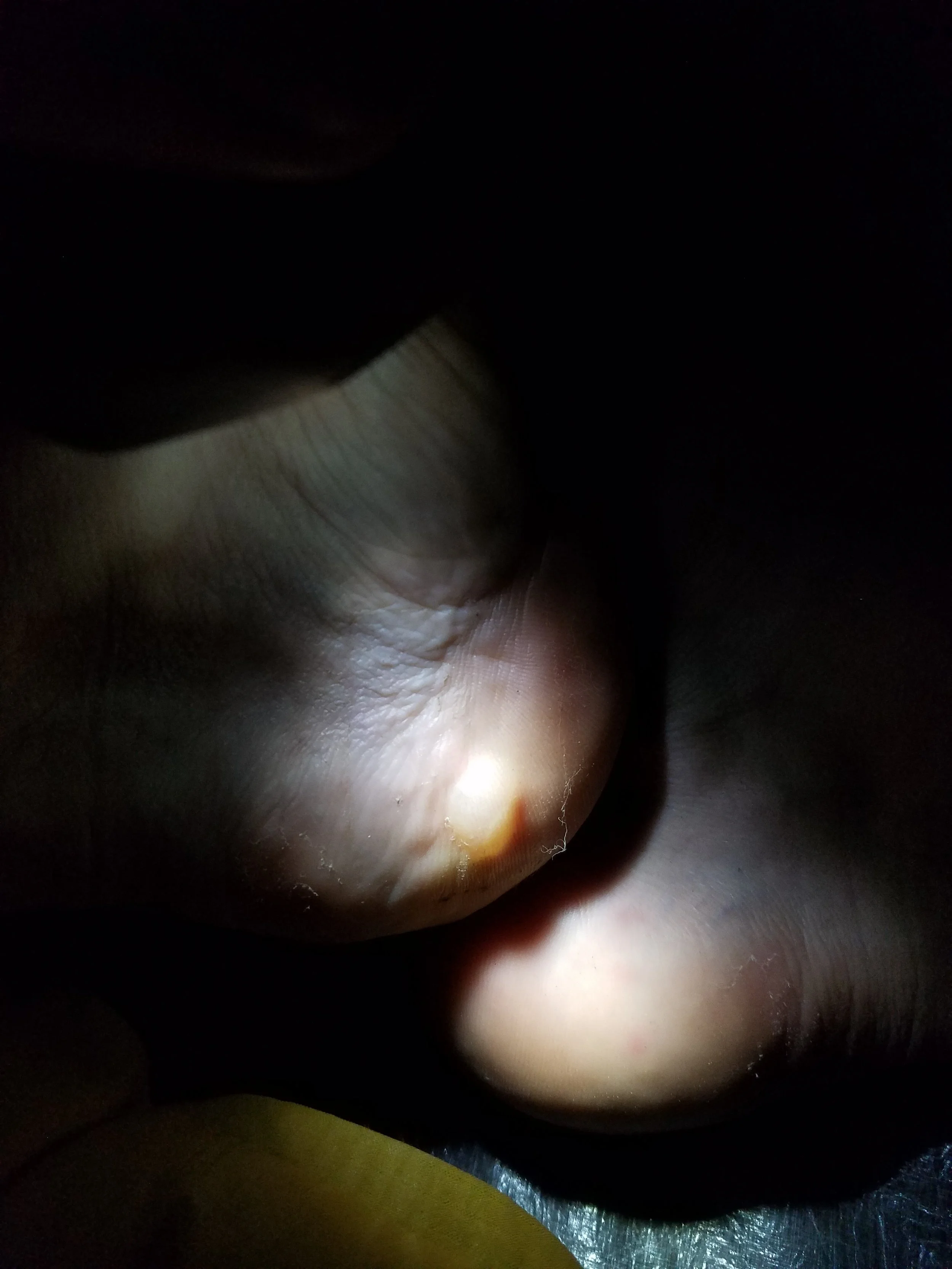 Ever-growing blisters from my wonderful shoes...