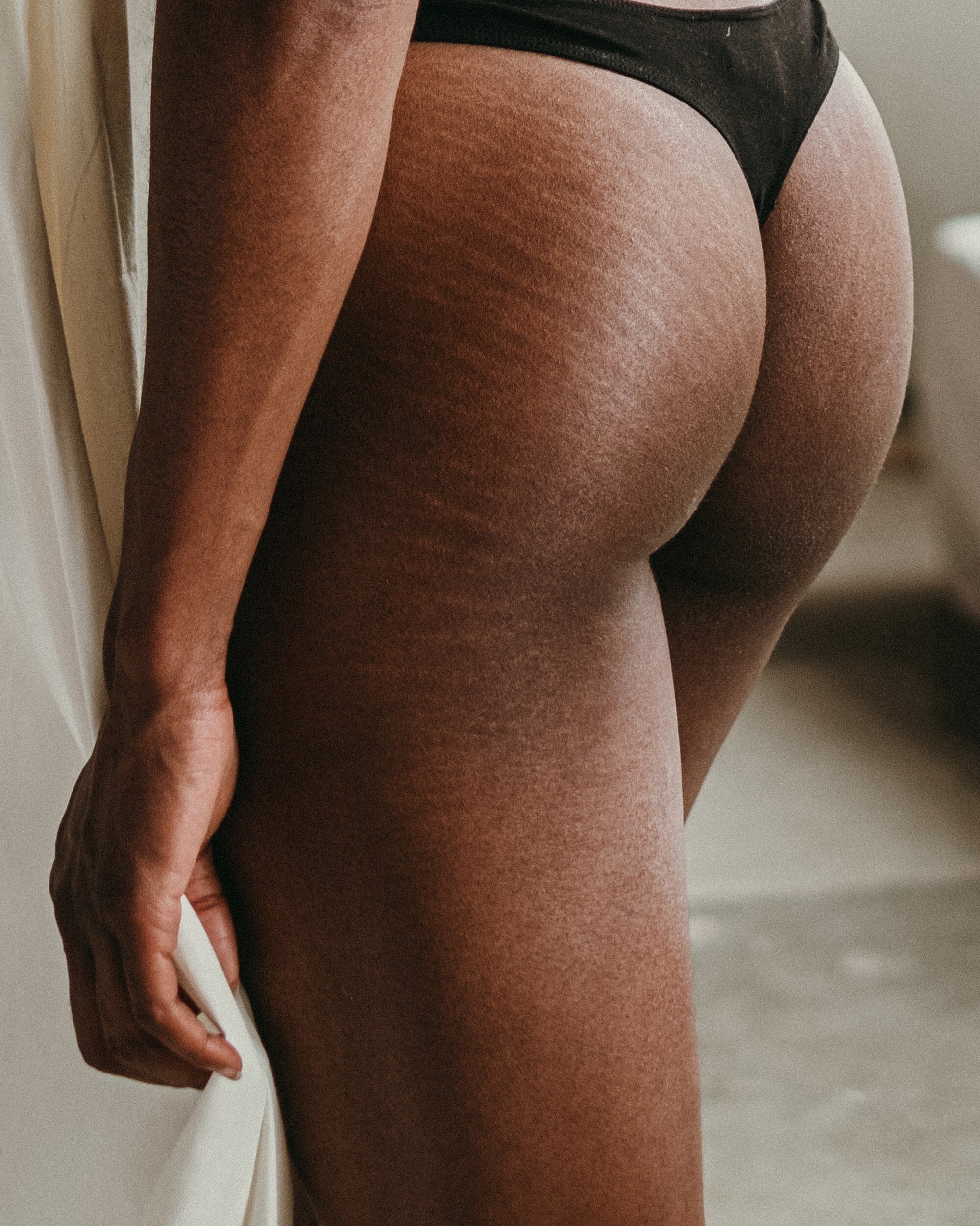 Stretch marks are not exclusive to the stomach or to pregnancy.