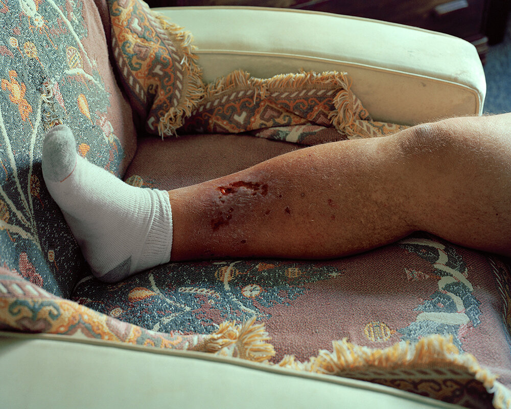 Mike's Leg