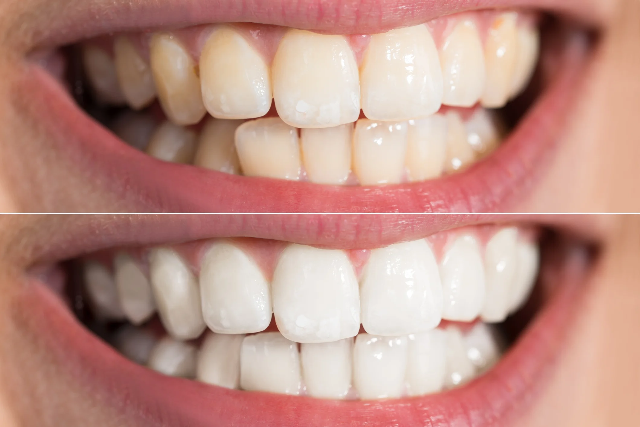 whitening - downloaded.jpg