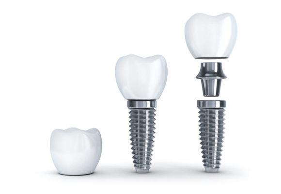 dental implant toorak crown.png