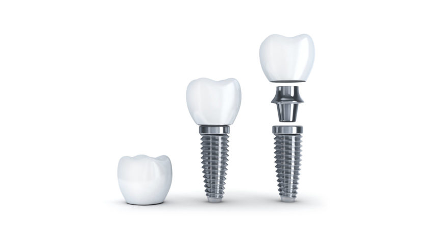 dental implant toorak.png