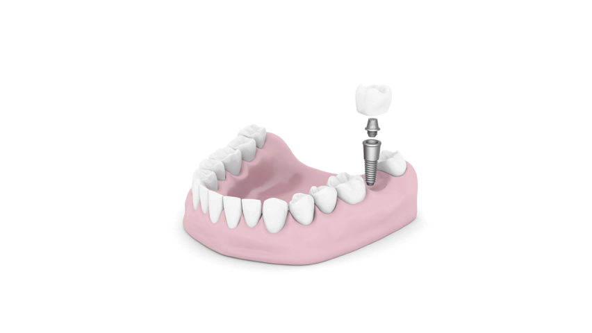 Dental Implants toorak Village.png