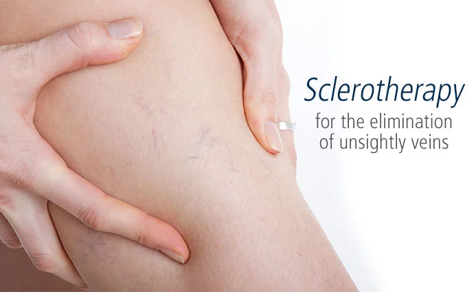 Sclerotherapy