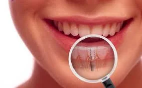 implants.jpg