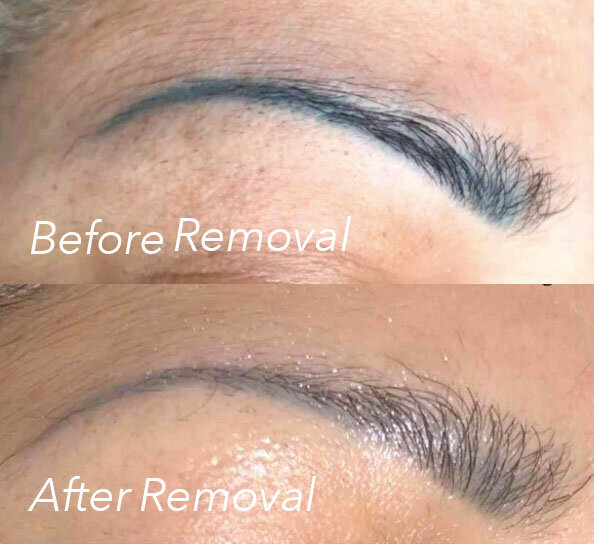 Permanent Makeup Removal & Color Correction