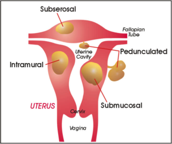 Uterine2.png