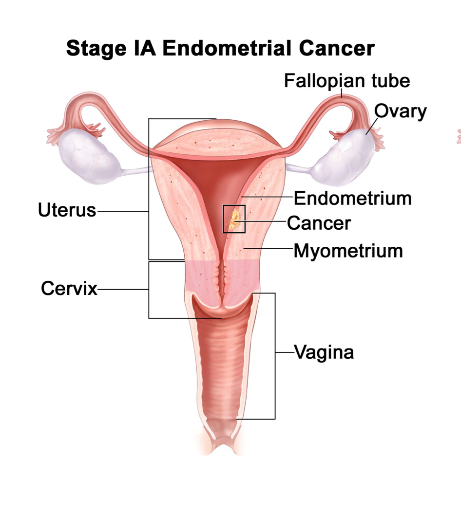 endometrial cancer is