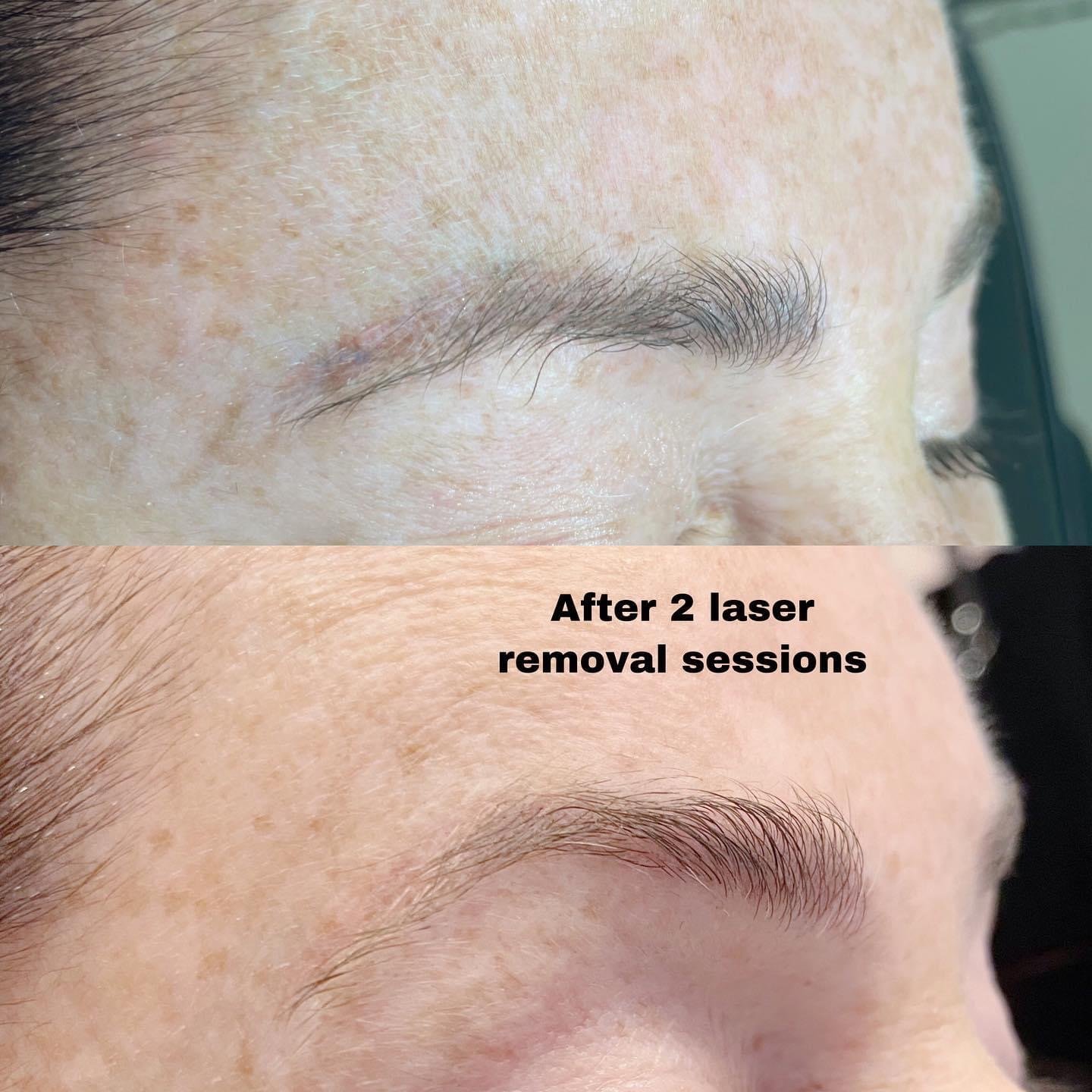 microblading removal bucks county.JPG