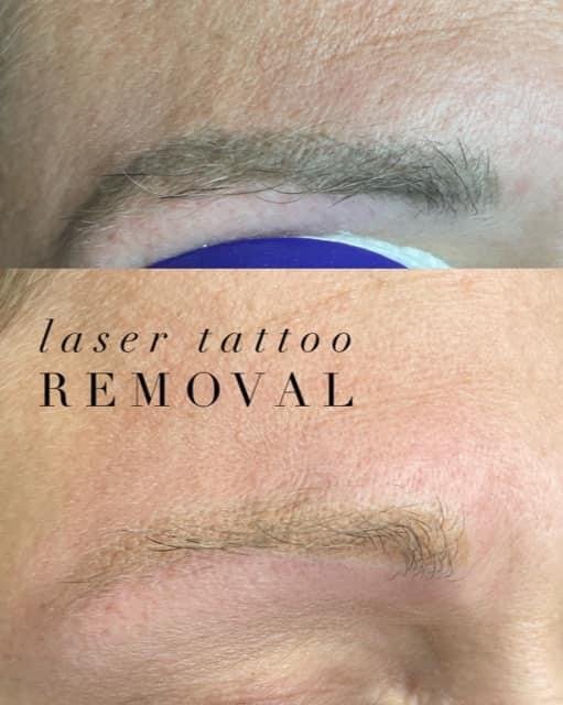 botched microblading new jersey, philly laser tattoo removal, maryland microblading, baltimore microblading, nj microblading.JPG