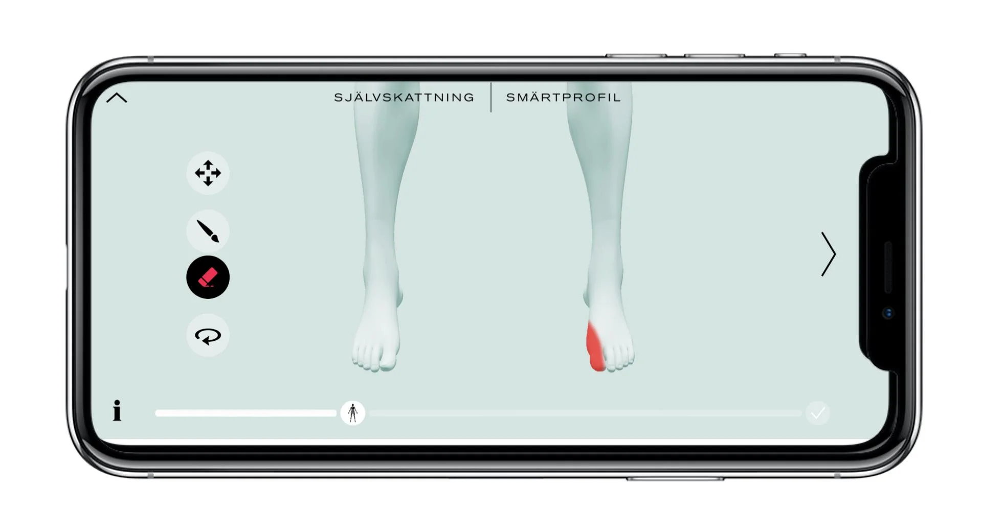 Hallux rigidus.jpg