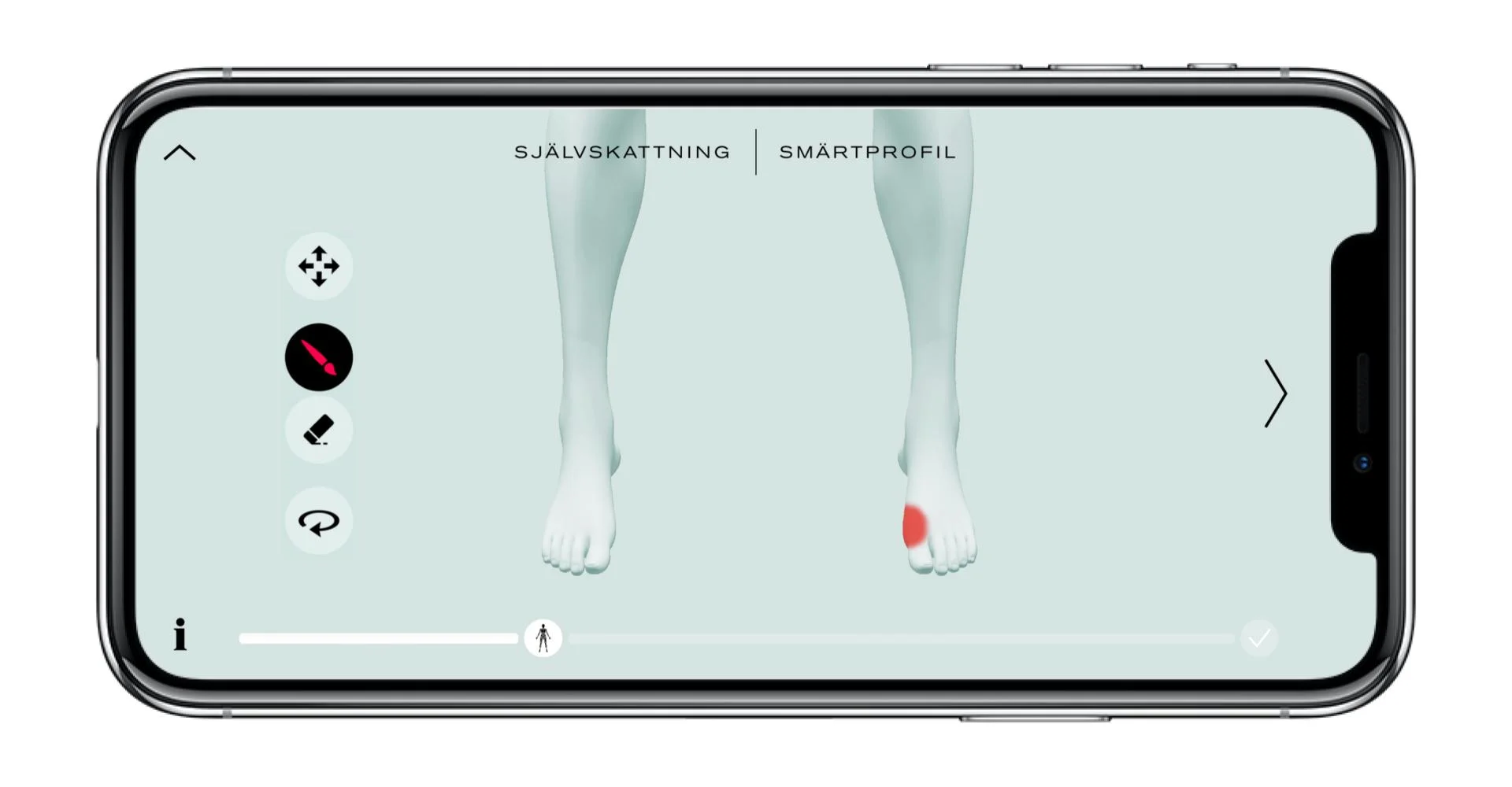 Hallux valgus.jpg