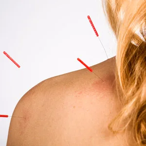 dry-needling_300x300.jpg