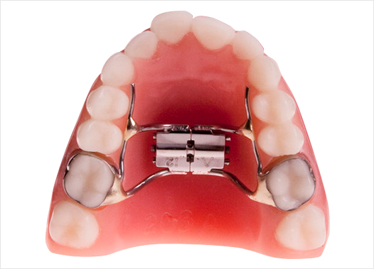 Straight Wire Braces are Creating Lifetime Memories - Westover Family Dental