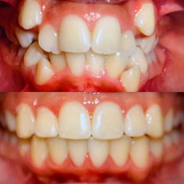 A little motivation for all our patients at home, the end goal is is in sight!! #transformationtuesday #beforeafter #braces #westernspringsorthodontist #itsnevertoolate