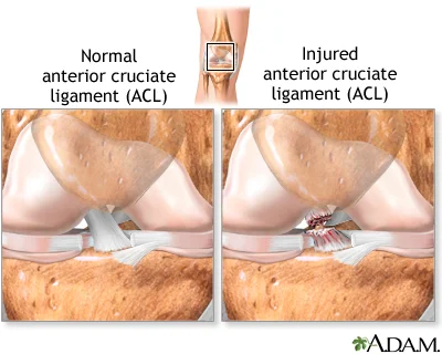 ACL-Illustration.jpg