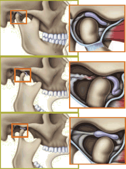 TMJ dysfunction.gif