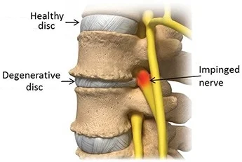 Spine showing degenerative disc disease