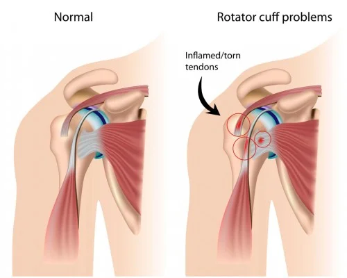 chiropractic patient with tendonitis and bursitis in the shoulder