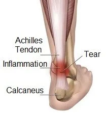 Achilles tendon inflammation and tear
