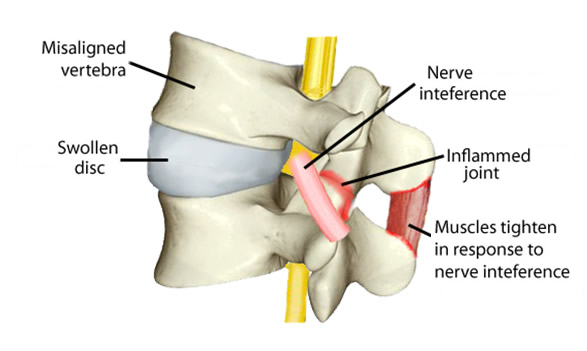 subluxation.jpg