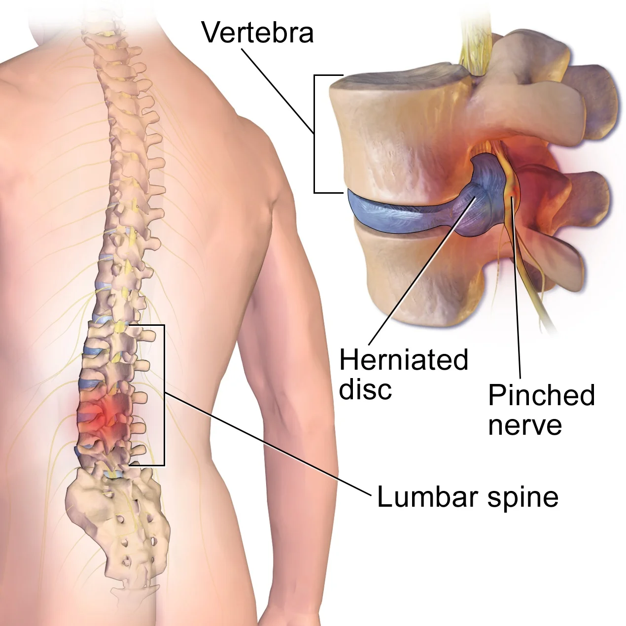 Herniated+Lumbar+Disc.jpg