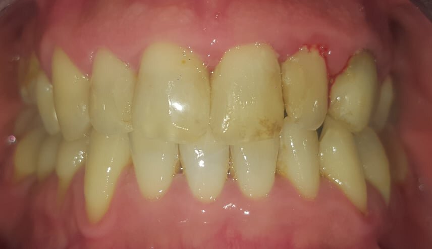 Coroas Facealis – Clínica Médico-Dentária