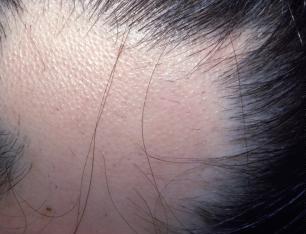Alopecia — Mehdi - Leech Therapist