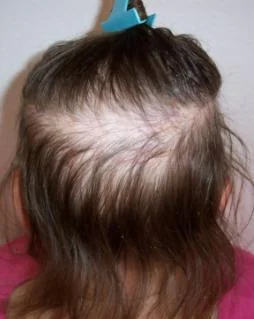 Female Alopecia