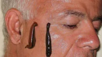 Leeches shown during treatment of varied conditions