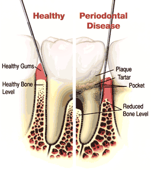 Healthy gums and gum disease