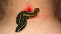 Leeches shown during treatment of varied conditions