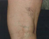 Example of spider veins