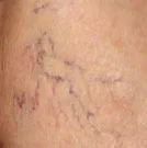 Example of spider veins