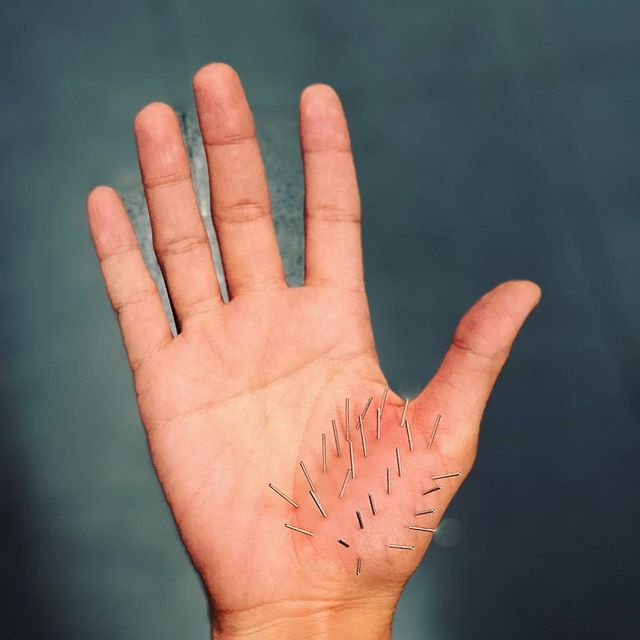 Korean Hand Acupuncture