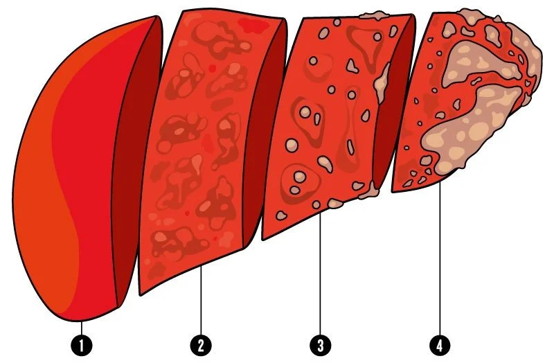 Stages of fibrosis, leading to cirrhosis