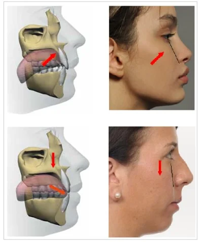 ORTHOTROPICS Orthotropics is a branch of dentistry that specialises in treating malocclusion by guiding the growth of the facial bones and correcting the oral environment. This treatment creates more space for the teeth and tongue. The main focus of this approach… By Ragul Gajendran