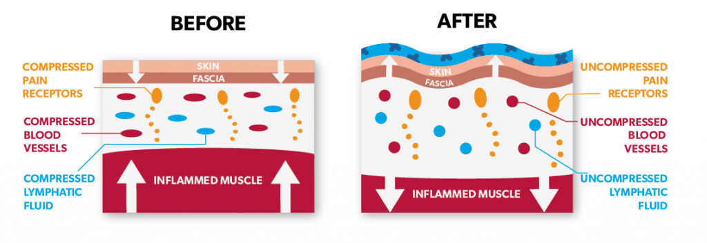 kinesio-tape.png