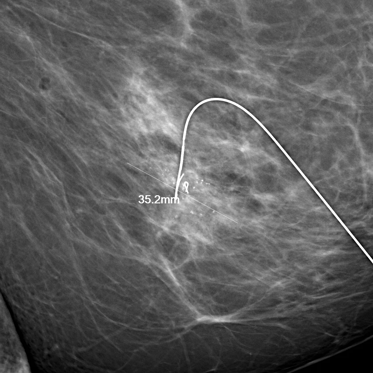 Surgical localization and planning on the Giotto. Direct measurement of the cancer and placement of localization devices with millimetric precision decreases reexcision rates while minimizing the amount of tissue that has to be removed.
