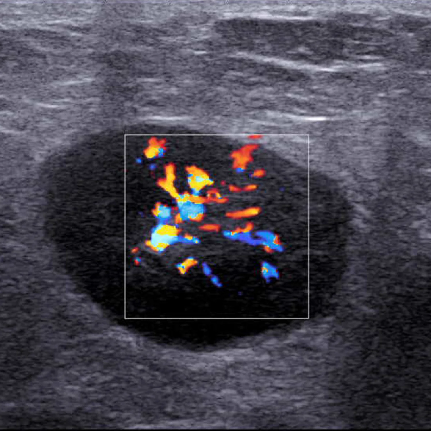 Color Doppler imaging of a malignant lymph node in a 55-year-old client with breast cancer.