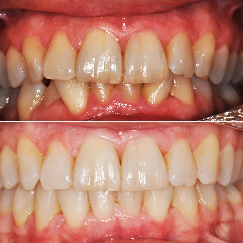 DST_Invisalign_banda_01.jpg