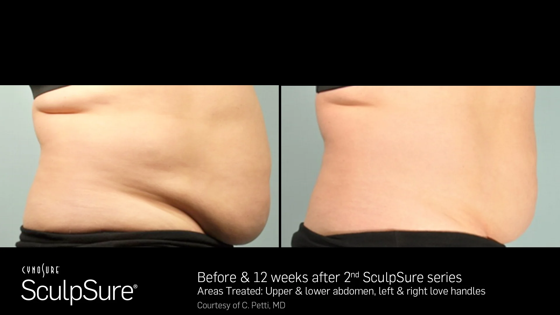 SculpSureBA_SidebySide_Female11.jpg