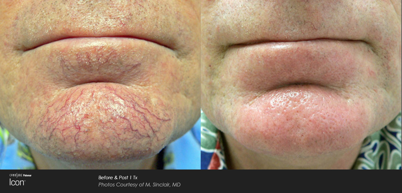 Photofacial A.png