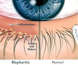 Seb-Blepharitis.jpg