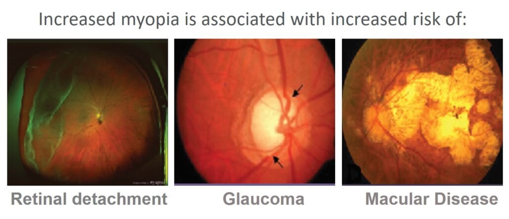 myopia-disease-1030x444.jpg