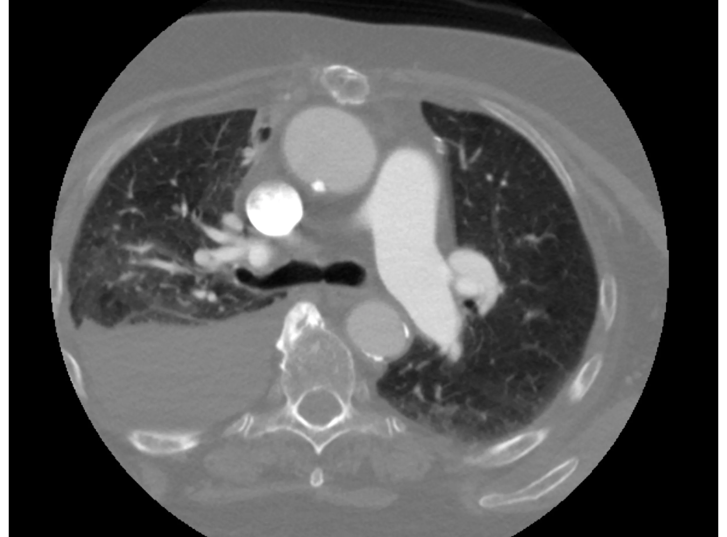 Figure 1: CT-angiogram of neck identifies significant pleural fluid collection